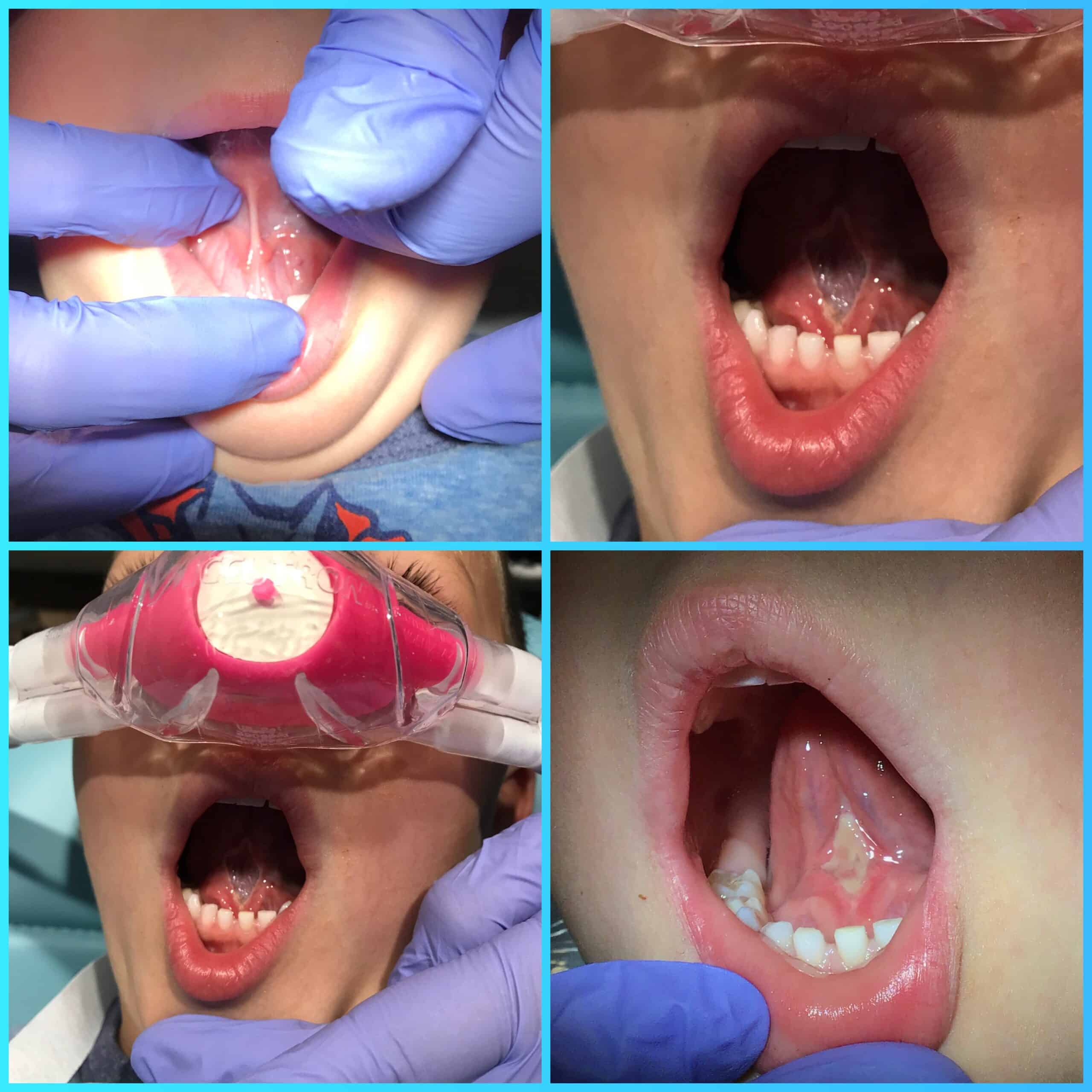 Shows progress of Tongue Tie Release Surgery